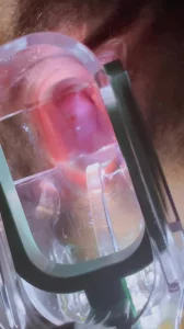 扩阴器